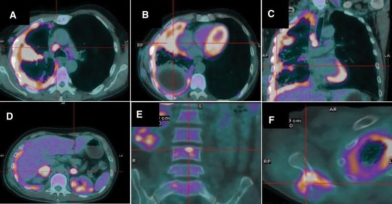 【佳学基因检测】基因检测鳞细胞肺癌EGFR突变伴PD-L1表达后的制定出帕博利珠单抗靶向药物治疗 【佳学基因检测】基因检测鳞细胞肺癌EGFR突变伴PD-L1表达后的制定出帕博利珠单抗靶向药物治疗